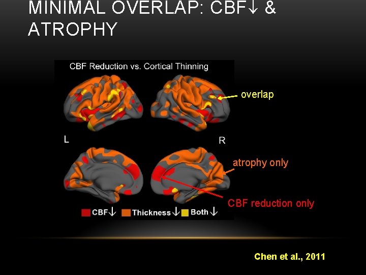 MINIMAL OVERLAP: CBF & ATROPHY overlap atrophy only CBF reduction only Chen et al.