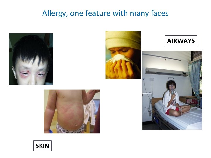 Allergy, one feature with many faces AIRWAYS SKIN 