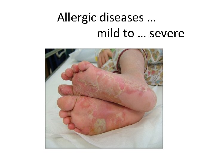 Allergic diseases … mild to … severe 