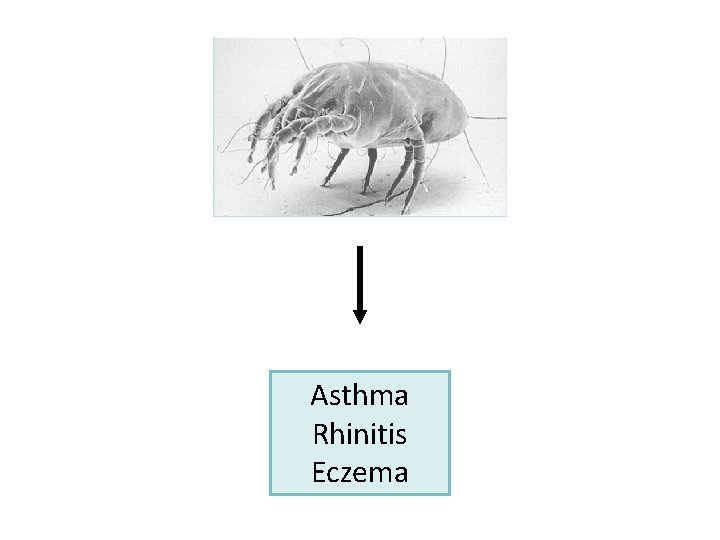 Asthma Rhinitis Eczema 
