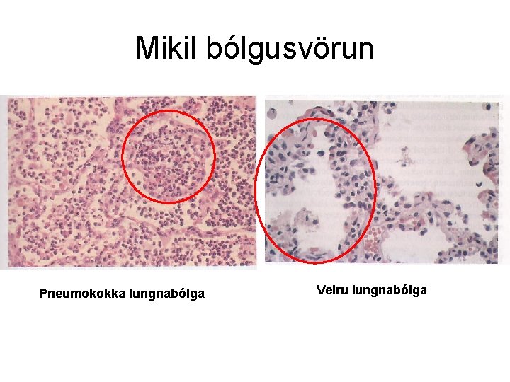 Mikil bólgusvörun Pneumokokka lungnabólga Veiru lungnabólga 