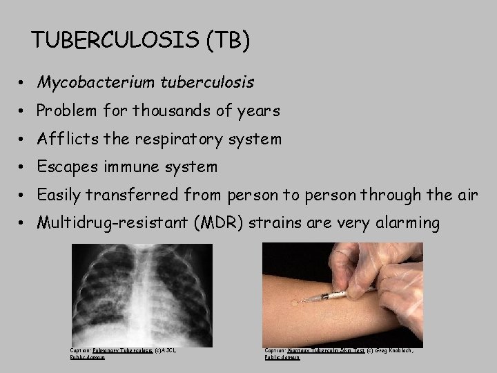 TUBERCULOSIS (TB) • Mycobacterium tuberculosis • Problem for thousands of years • Afflicts the