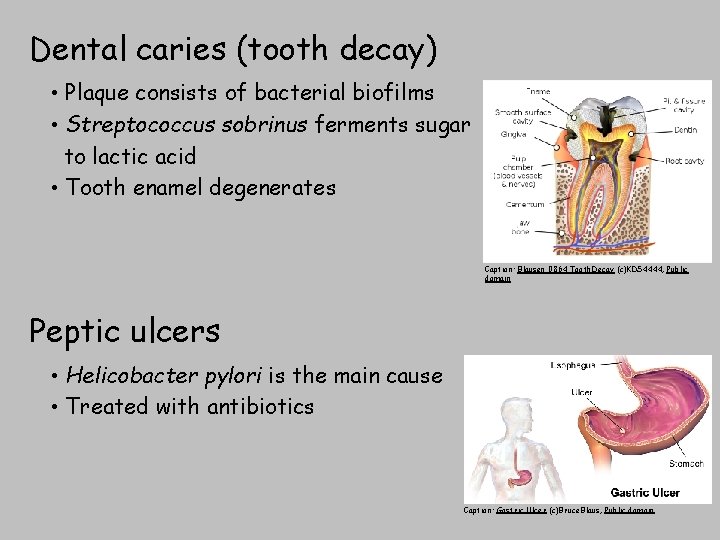 Dental caries (tooth decay) • Plaque consists of bacterial biofilms • Streptococcus sobrinus ferments
