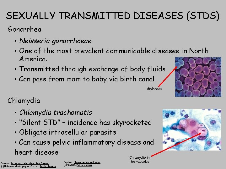 SEXUALLY TRANSMITTED DISEASES (STDS) Gonorrhea • Neisseria gonorrhoeae • One of the most prevalent