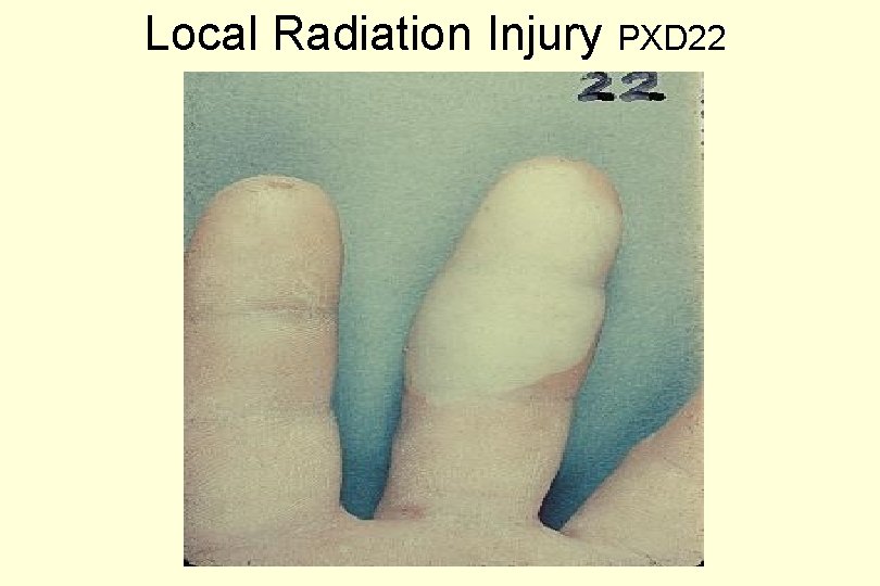 Local Radiation Injury PXD 22 