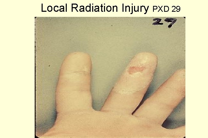 Local Radiation Injury PXD 29 
