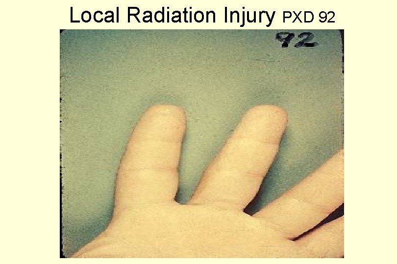 Local Radiation Injury PXD 92 