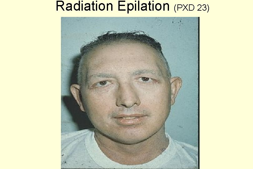 Radiation Epilation (PXD 23) 