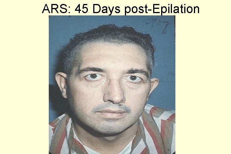 ARS: 45 Days post-Epilation 