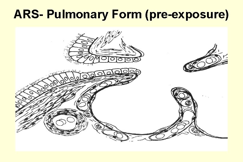 ARS- Pulmonary Form (pre-exposure) 