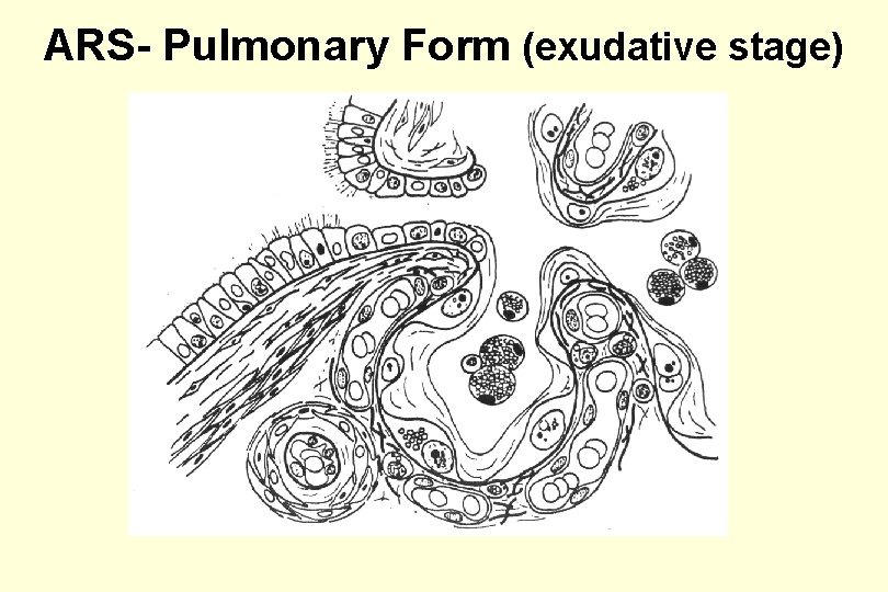 ARS- Pulmonary Form (exudative stage) 
