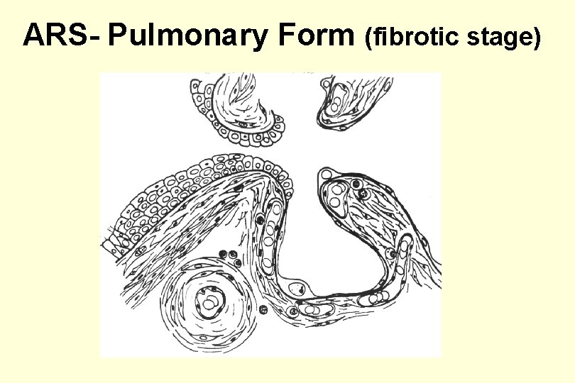 ARS- Pulmonary Form (fibrotic stage) 