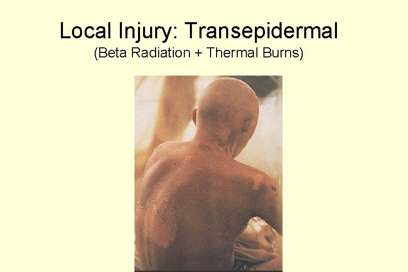 Local Injury: Transepidermal (Beta Radiation + Thermal Burns) 