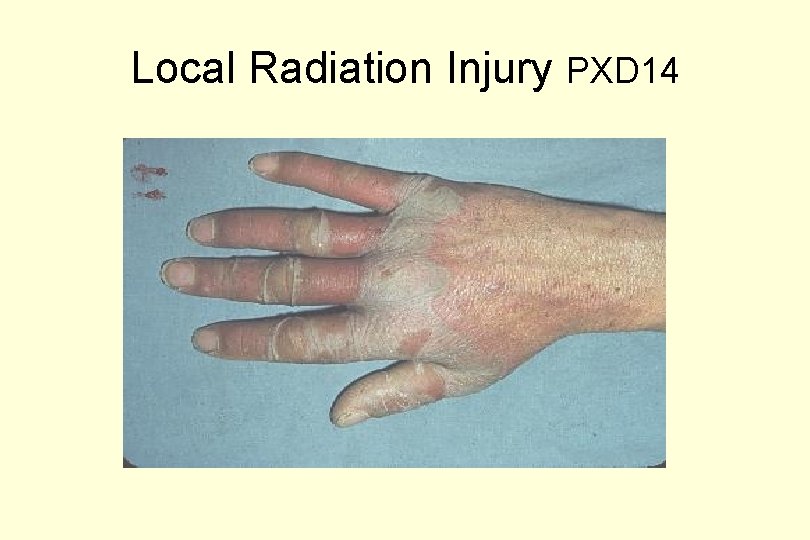 Local Radiation Injury PXD 14 