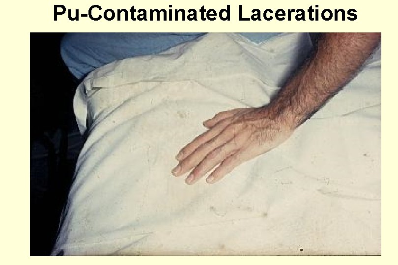 Pu-Contaminated Lacerations 