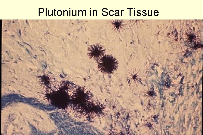Plutonium in Scar Tissue 