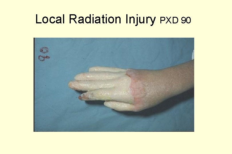 Local Radiation Injury PXD 90 