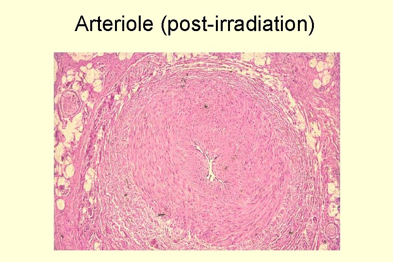 Arteriole (post-irradiation) 