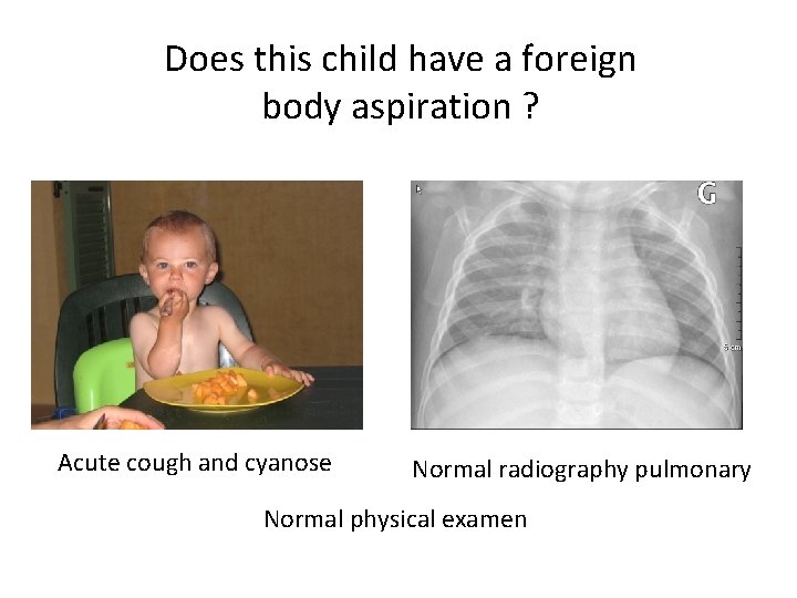 Does this child have a foreign body aspiration ? Acute cough and cyanose Normal