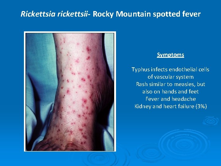 Rickettsia rickettsii- Rocky Mountain spotted fever Symptoms Typhus infects endothelial cells of vascular system