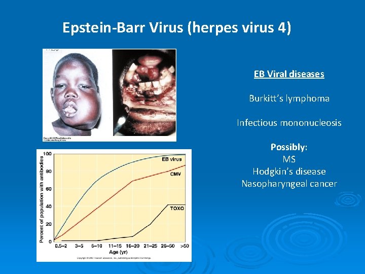 Epstein-Barr Virus (herpes virus 4) EB Viral diseases Burkitt’s lymphoma Infectious mononucleosis Possibly: MS