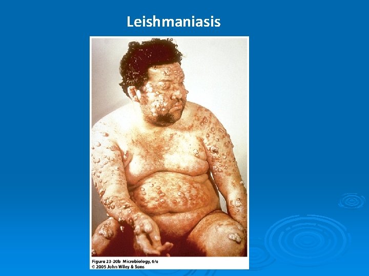 Leishmaniasis 