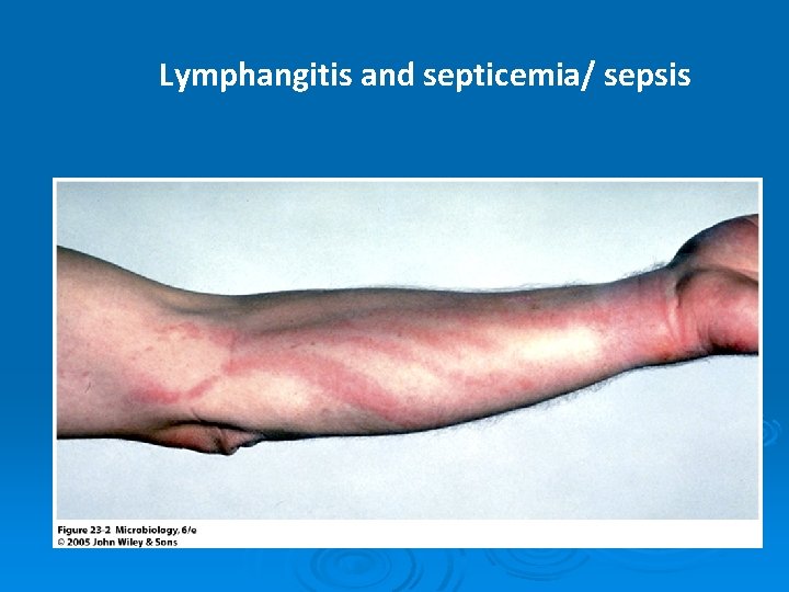 Lymphangitis and septicemia/ sepsis 