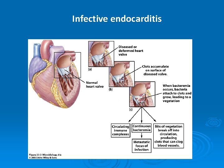 Infective endocarditis 