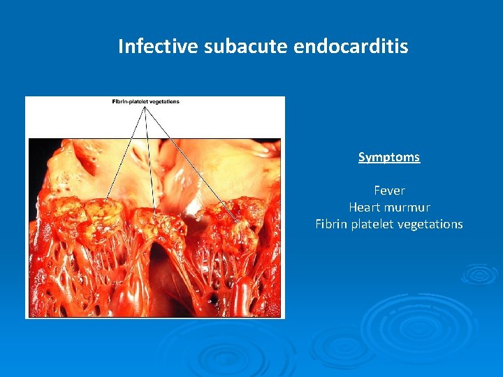 Infective subacute endocarditis Symptoms Fever Heart murmur Fibrin platelet vegetations 