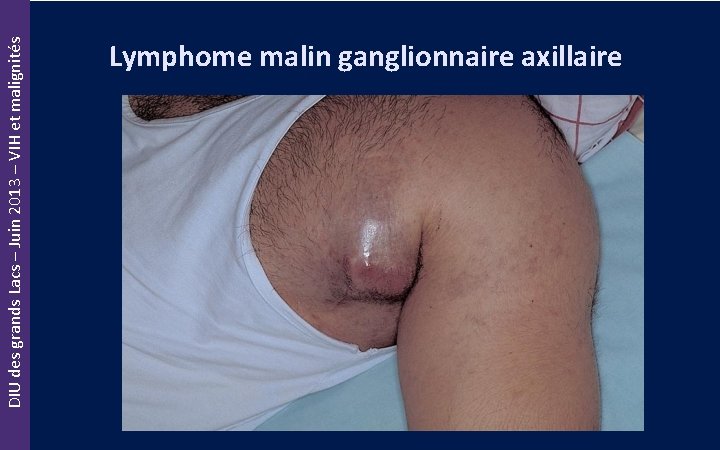 DIU des grands Lacs – Juin 2013 – VIH et malignités Lymphome malin ganglionnaire
