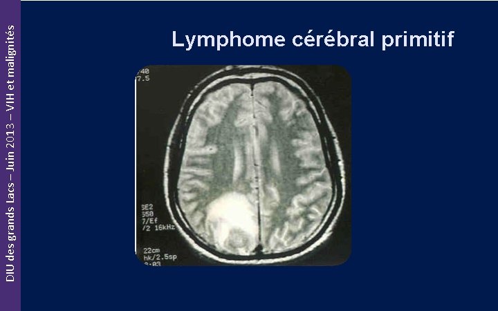 DIU des grands Lacs – Juin 2013 – VIH et malignités Lymphome cérébral primitif