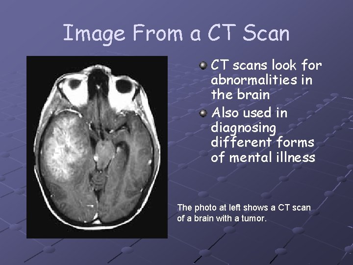 Image From a CT Scan CT scans look for abnormalities in the brain Also