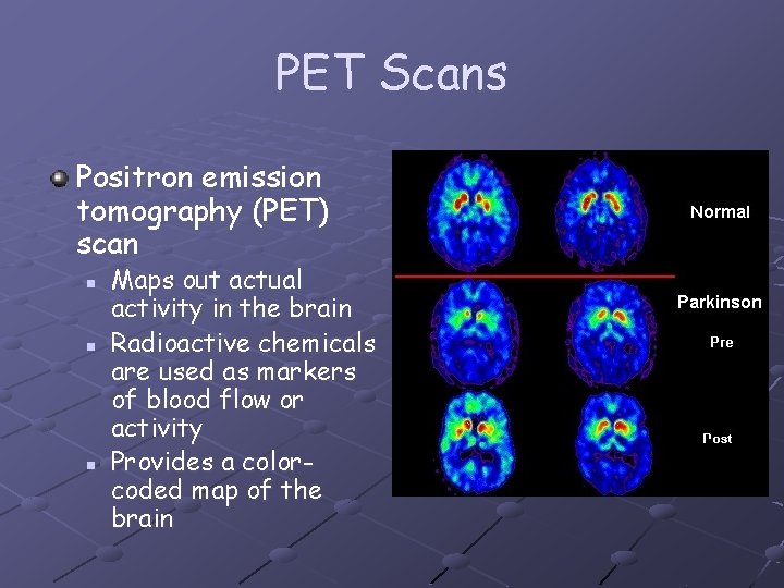 PET Scans Positron emission tomography (PET) scan n Maps out actual activity in the