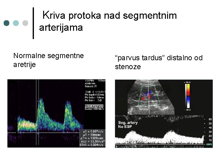 Kriva protoka nad segmentnim arterijama Normalne segmentne aretrije “parvus tardus” distalno od stenoze 