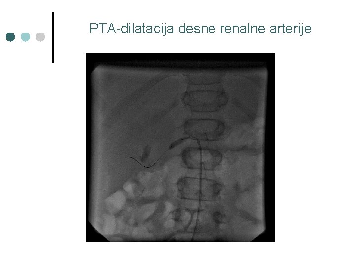 PTA-dilatacija desne renalne arterije 