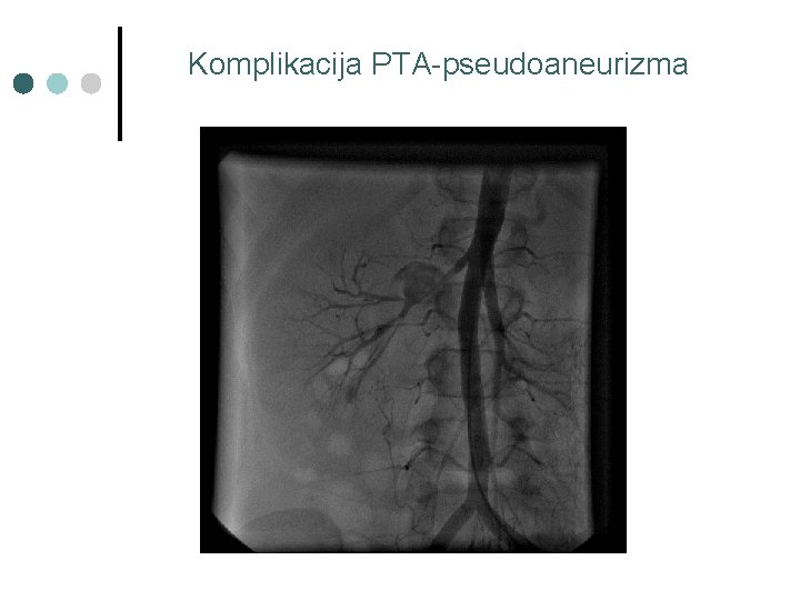 Komplikacija PTA-pseudoaneurizma 