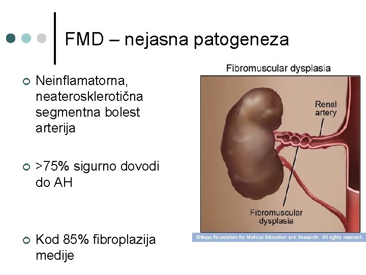 FMD – nejasna patogeneza ¢ Neinflamatorna, neaterosklerotična segmentna bolest arterija ¢ >75% sigurno dovodi