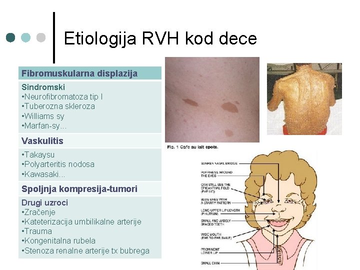 Etiologija RVH kod dece Fibromuskularna displazija Sindromski • Neurofibromatoza tip I • Tuberozna skleroza