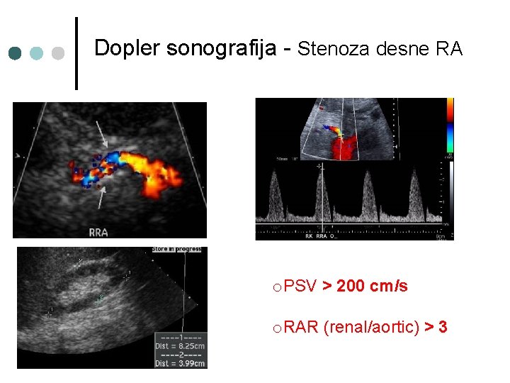 Dopler sonografija - Stenoza desne RA o. PSV > 200 cm/s o. RAR (renal/aortic)