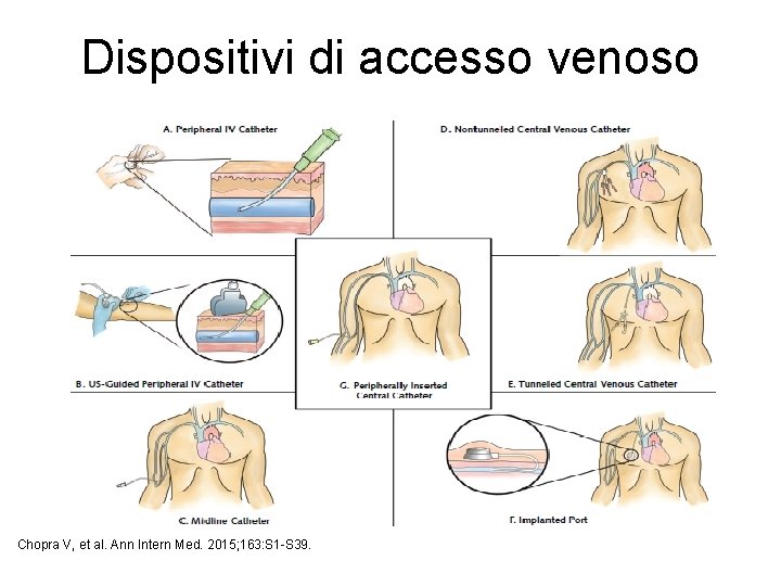 Dispositivi di accesso venoso Chopra V, et al. Ann Intern Med. 2015; 163: S