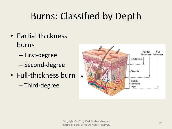 Burns: Classified by Depth • Partial thickness burns – First-degree – Second-degree • Full-thickness