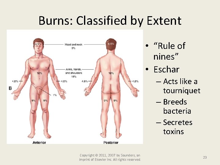 Burns: Classified by Extent • “Rule of nines” • Eschar – Acts like a
