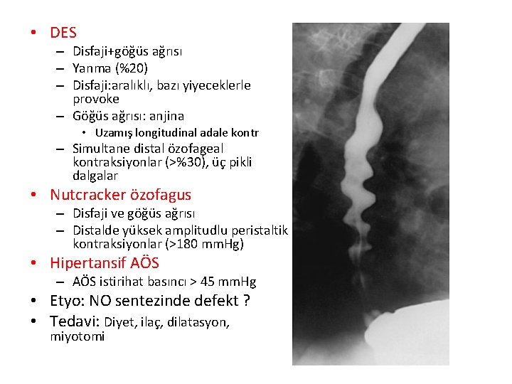  • DES – Disfaji+göğüs ağrısı – Yanma (%20) – Disfaji: aralıklı, bazı yiyeceklerle