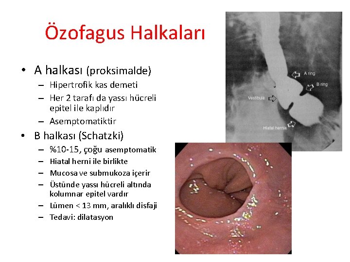 Özofagus Halkaları • A halkası (proksimalde) – Hipertrofik kas demeti – Her 2 tarafı