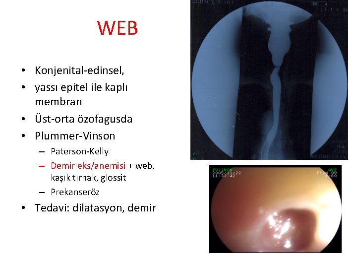 WEB • Konjenital-edinsel, • yassı epitel ile kaplı membran • Üst-orta özofagusda • Plummer-Vinson