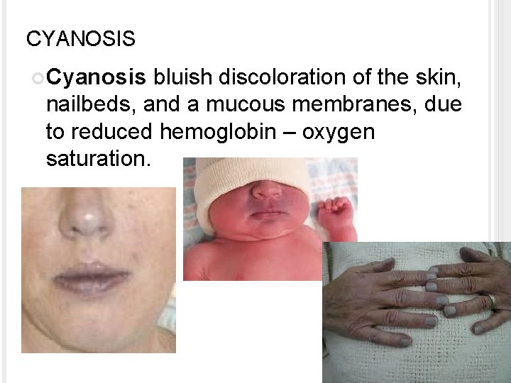 CYANOSIS Cyanosis bluish discoloration of the skin, nailbeds, and a mucous membranes, due to