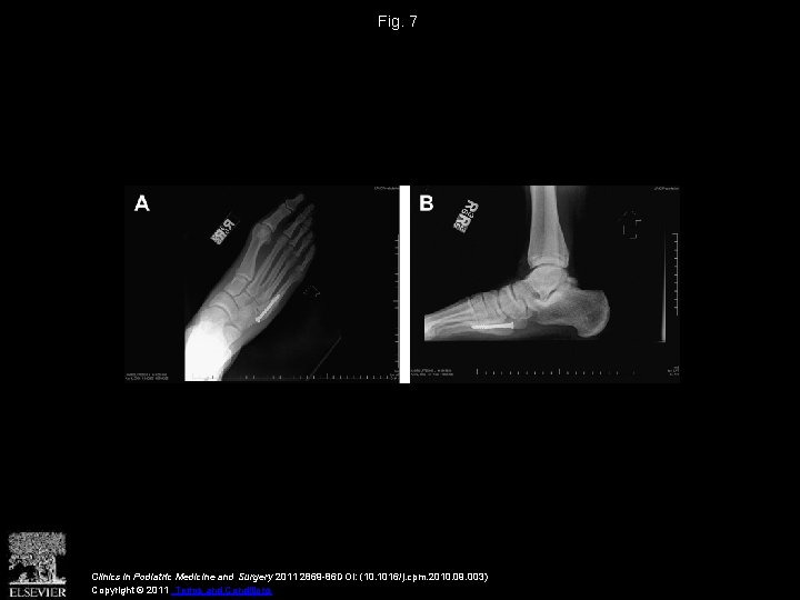 Fig. 7 Clinics in Podiatric Medicine and Surgery 2011 2869 -86 DOI: (10. 1016/j.