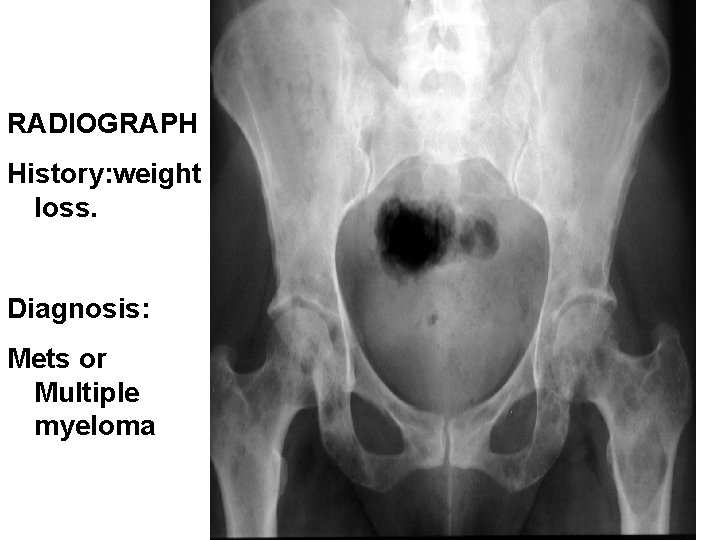 RADIOGRAPH History: weight loss. Diagnosis: Mets or Multiple myeloma 