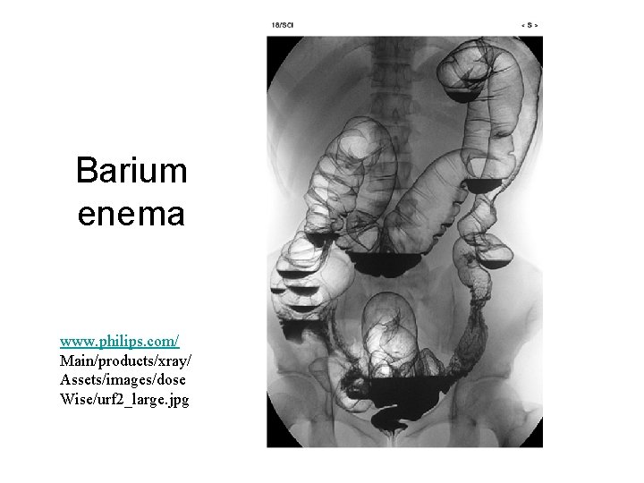 Barium enema www. philips. com/ Main/products/xray/ Assets/images/dose Wise/urf 2_large. jpg 