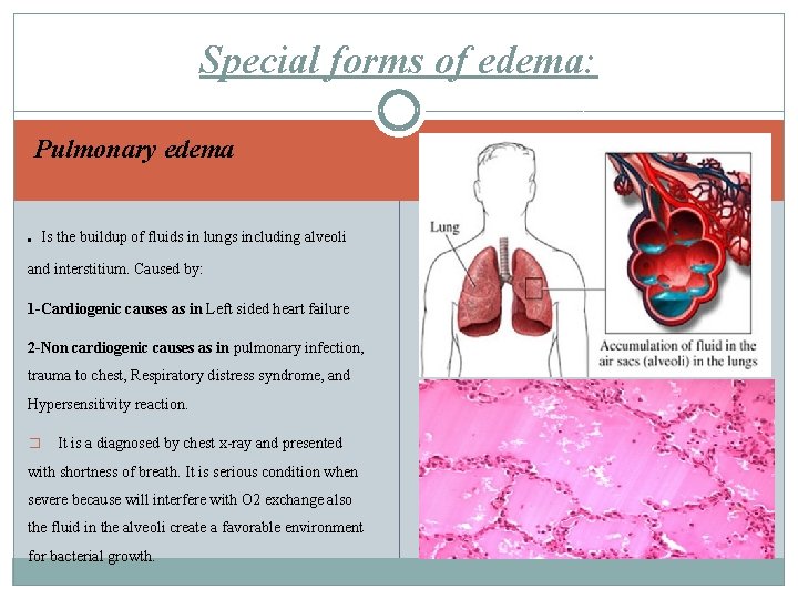 Special forms of edema: Pulmonary edema. Is the buildup of fluids in lungs including